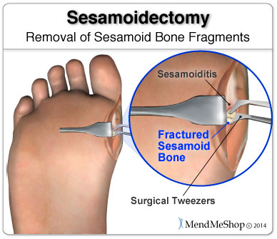 The sesamoid bones are accessed through an incision on the side of the foot.