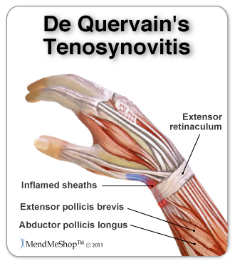 Tenosinovitis de Quervain (Tendinitis extensor del pulgar) – MEDS