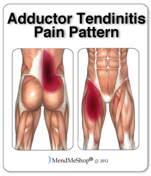 Adductor Tendonitis pain in your groin and back