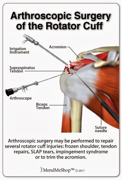 arthroscopic tendon repair surgery