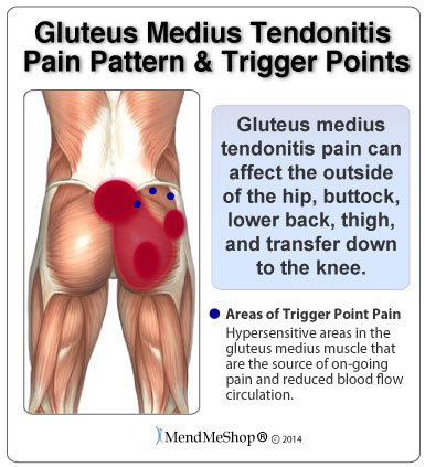 Gluteus medius tendonitis pain pattern trigger points