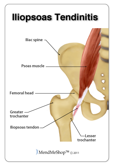 hip flexor Tendonitis location in your hip