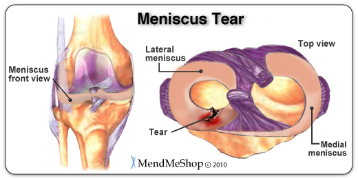 knee pain may be a meniscus injury