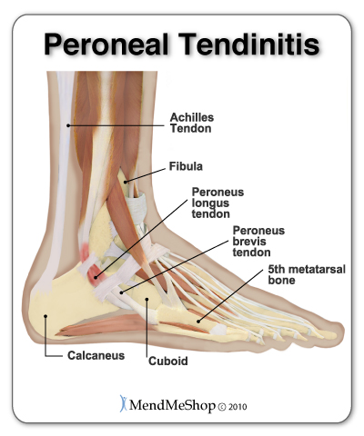 Peroneal tendonitis (tendinitis) is inflammation of the peroneal tendons located on the outside of the ankle.
