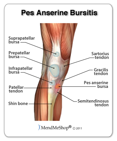 knee bursitis, pain and swelling below the knee cap