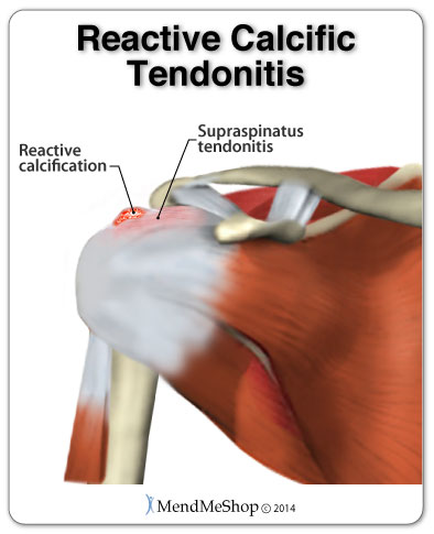 The cause or reactive calcific Tendonitis is unknown but symptoms present in 3 stages
