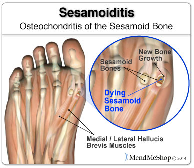 Sesamoiditis can sometimes involve a break or fracture to your sesamoid bone.