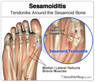 Sometimes the tendons around the sesamoid bones will become inflamed and irritated.