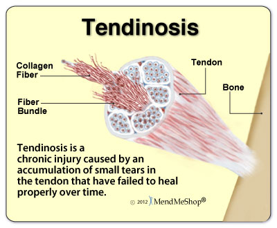 microscopic view of tendinosis