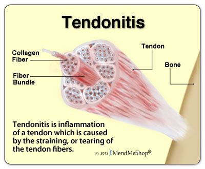 Tendonitis is inflammation of a tendon from micro-tearing of the tissue.