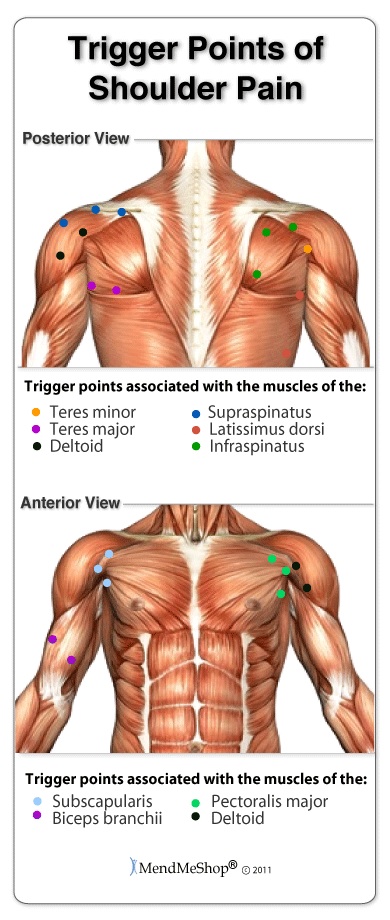 Trigger Points Related to tendonosis and Tendonitis